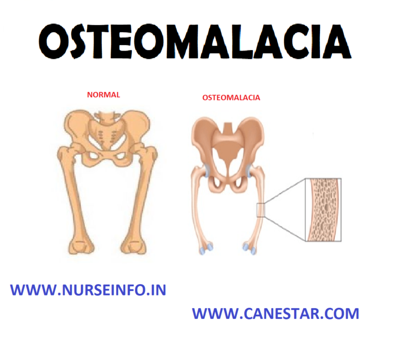 Osteomalacia Nurse Info