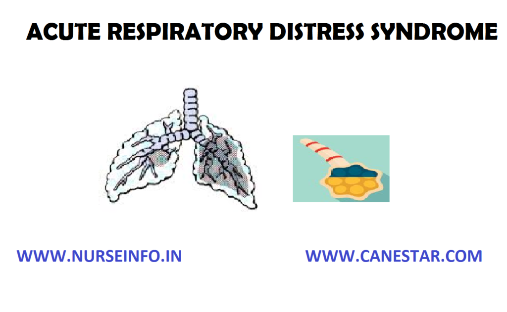 ACUTE RESPIRATORY DISTRESS SYNDROME (ARDS) – Clinical Manifestations, Pathophysiology, Assessment and Diagnostic Findings and Management 