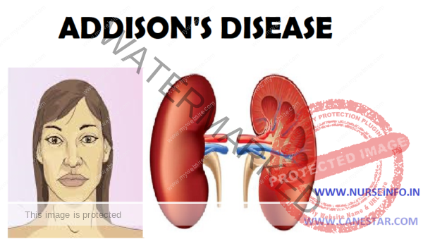 ADDISON’S DISEASE (ADRENAL INSUFFICIENCY) - Nurse Info