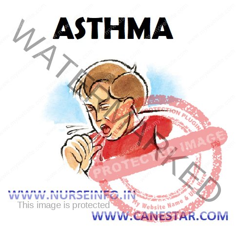 ASTHMA – Etiology, Risk Factors, Pathophysiology, Signs and Symptoms, Diagnostic Evaluations and Management 