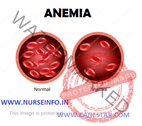 ANEMIA – Etiology, Classification, Clinical Manifestations and Management 