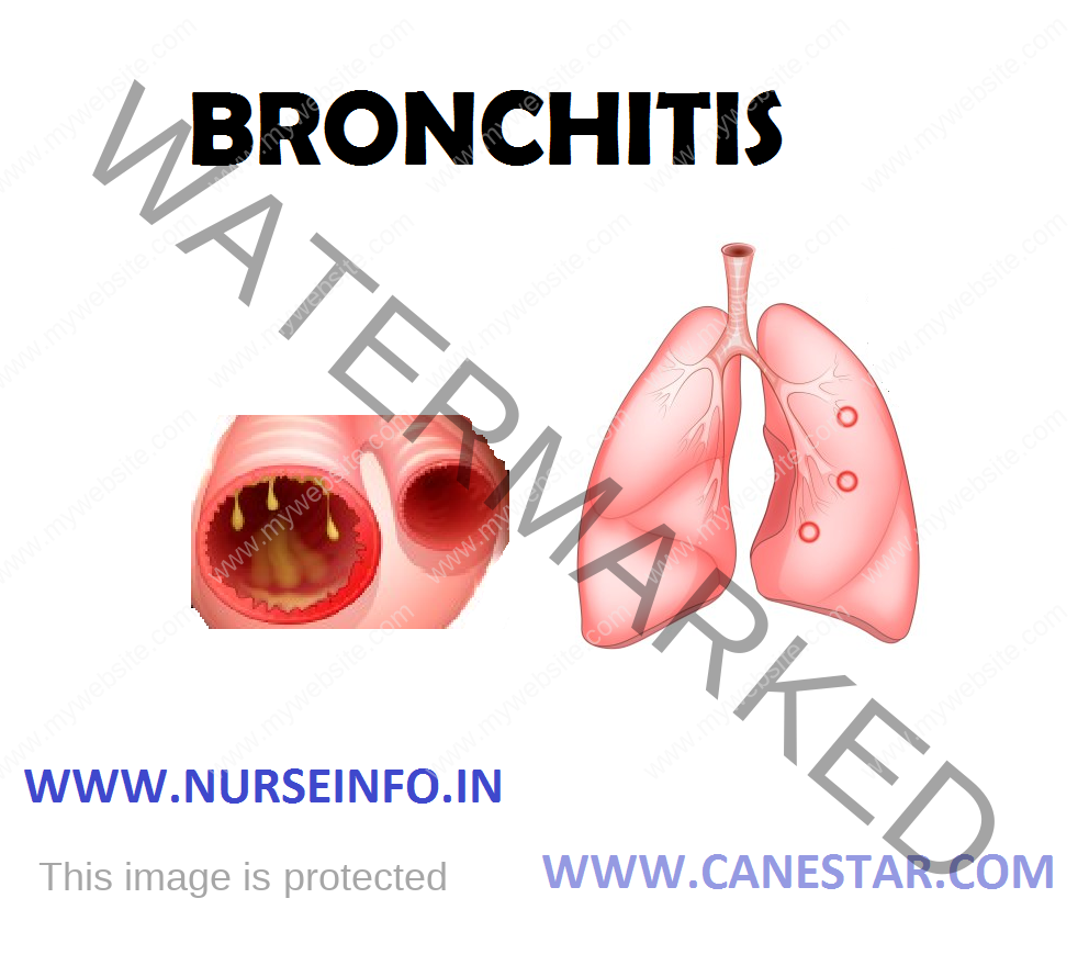 BRONCHITIS – Etiology, Risk Factors, Pathophysiology, Clinical Manifestations, Complications, Diagnostic Evaluations and Management 