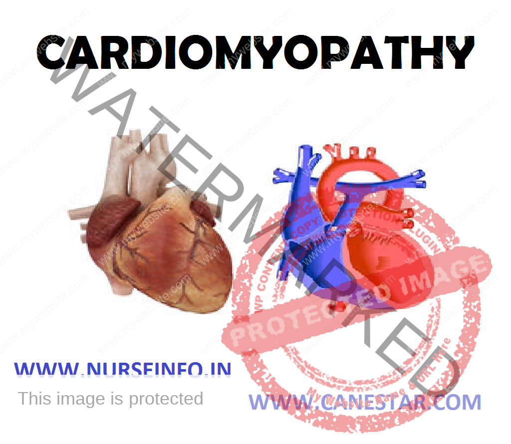 CARDIOMYOPATHY – Etiology, Signs and Symptoms, Diagnostic Evaluation, Treatment and Management 