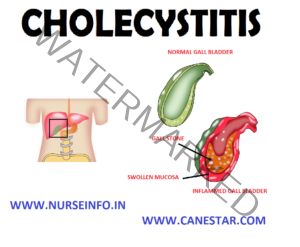 CHOLECYSTITIS - Nurse Info