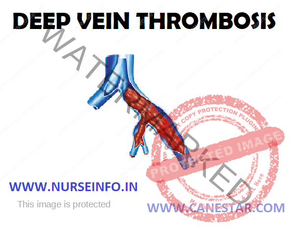 DEEP VEIN THROMBOSIS – Etiology, Risk Factors, Pathophysiology, Clinical Manifestation, Diagnostic Evaluation and Management (Surgical and Nursing) 