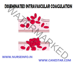 DISSEMINATED INTRAVASCULAR COAGULATION (DIC) - Nurse Info