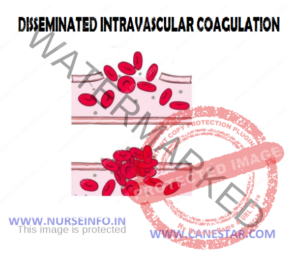 Disseminated Intravascular Coagulation Symptoms