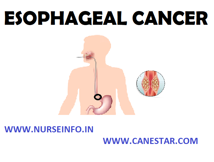 ESOPHAGEAL CANCER - Definition, Etiology, Types, Stages, Signs and Symptoms, Diagnostic Evaluation and Management