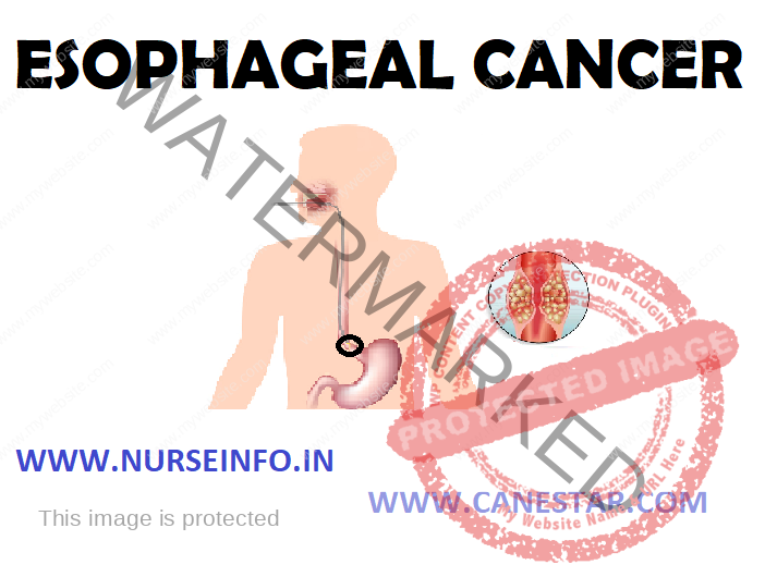 ESOPHAGEAL CANCER - Definition, Etiology, Types, Stages, Signs and Symptoms, Diagnostic Evaluation and Management 