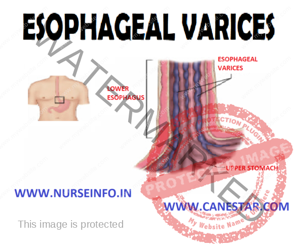 esophageal-varices-nurse-info