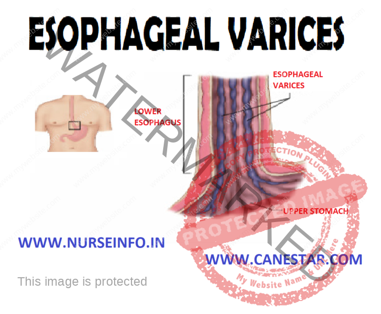 ESOPHAGEAL VARICES Nurse Info