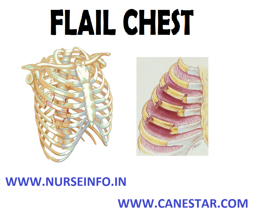 FLAIL CHEST – Characteristics, Etiology, Signs and Symptoms and Treatment 