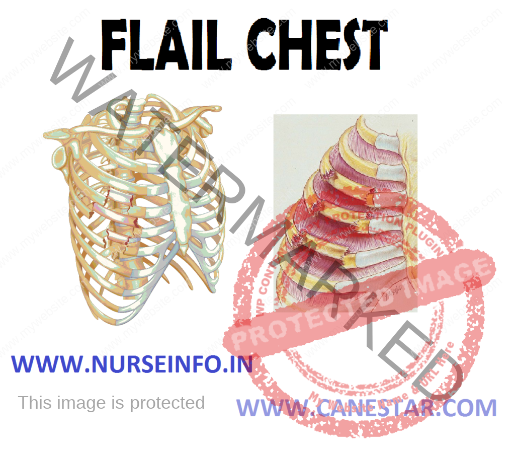 FLAIL CHEST – Characteristics, Etiology, Signs and Symptoms and Treatment 