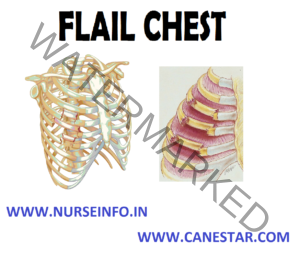 FLAIL CHEST - Nurse Info