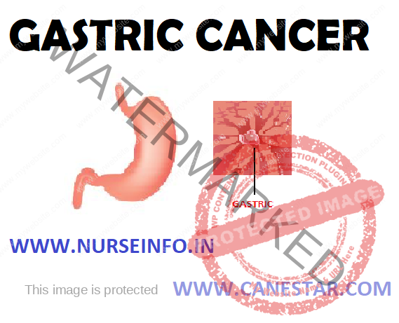 GASTRIC CANCER – Causes and Risk Factors, Pathophysiology, Signs and Symptoms, Stages, Diagnosis and Management 