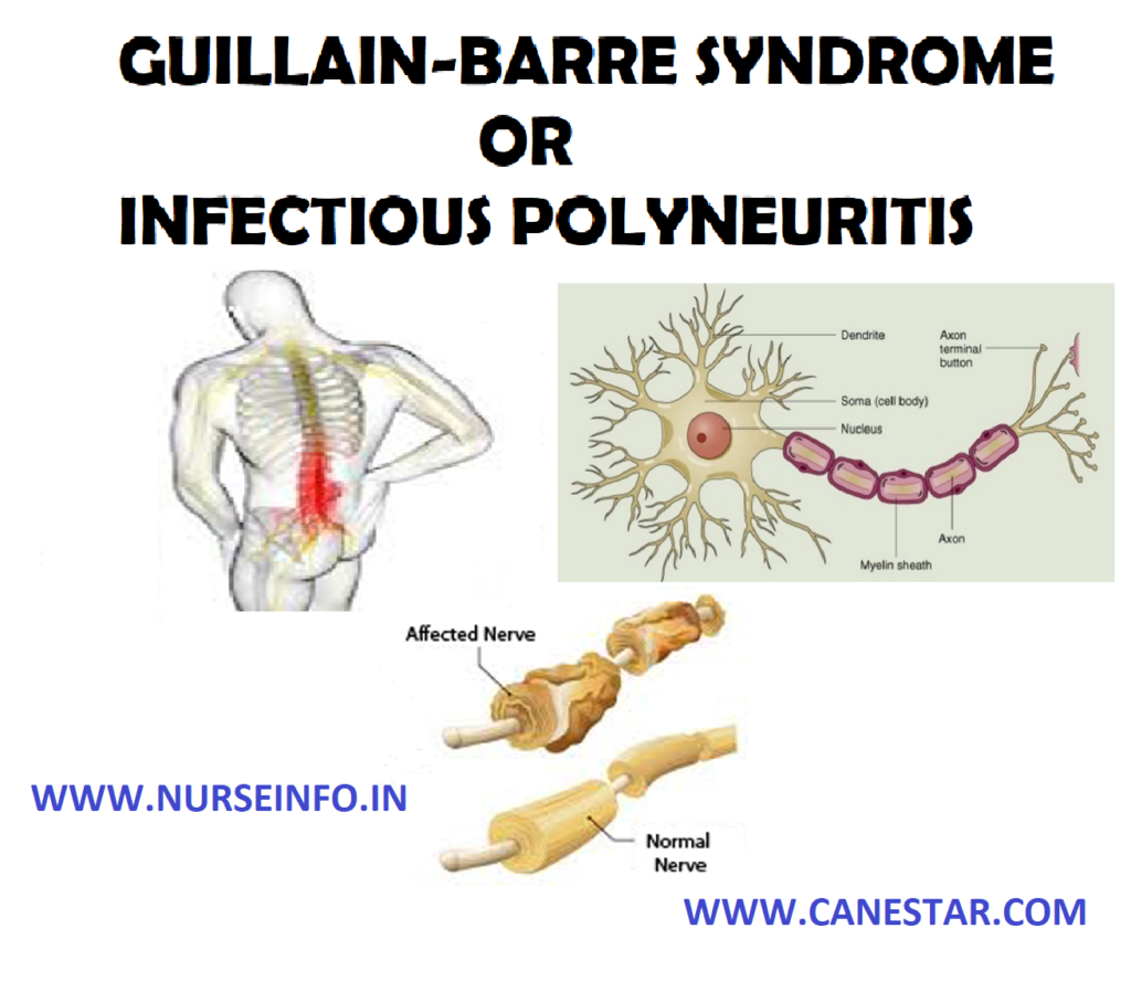 GUILLAIN-BARRE SYNDROME OR INFECTIOUS POLYNEURITIS - Etiology, Pathophysiology, Signs and Symptoms, Diagnostic Evaluation and Management 