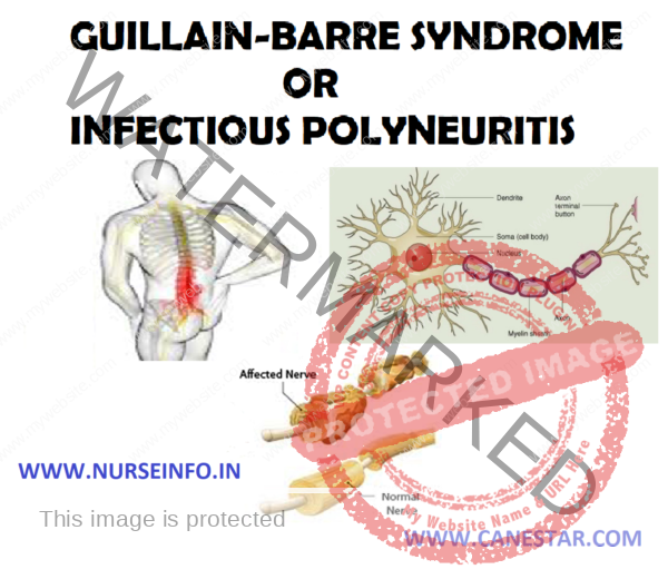 GUILLAIN-BARRE SYNDROME OR INFECTIOUS POLYNEURITIS - Nurse Info