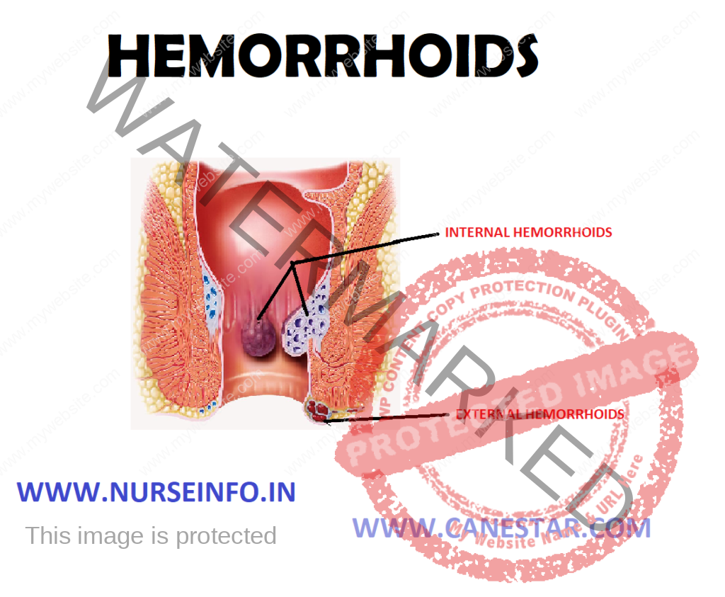 HEMORRHOIDS – Etiology, Types, Pathophysiology, Diagnostic Evaluation and Management 