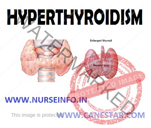 HYPERTHYROIDISM – Etiology, Pathophysiology, Symptoms, Complications, Clinical Features, Diagnostic Evaluation and Management 