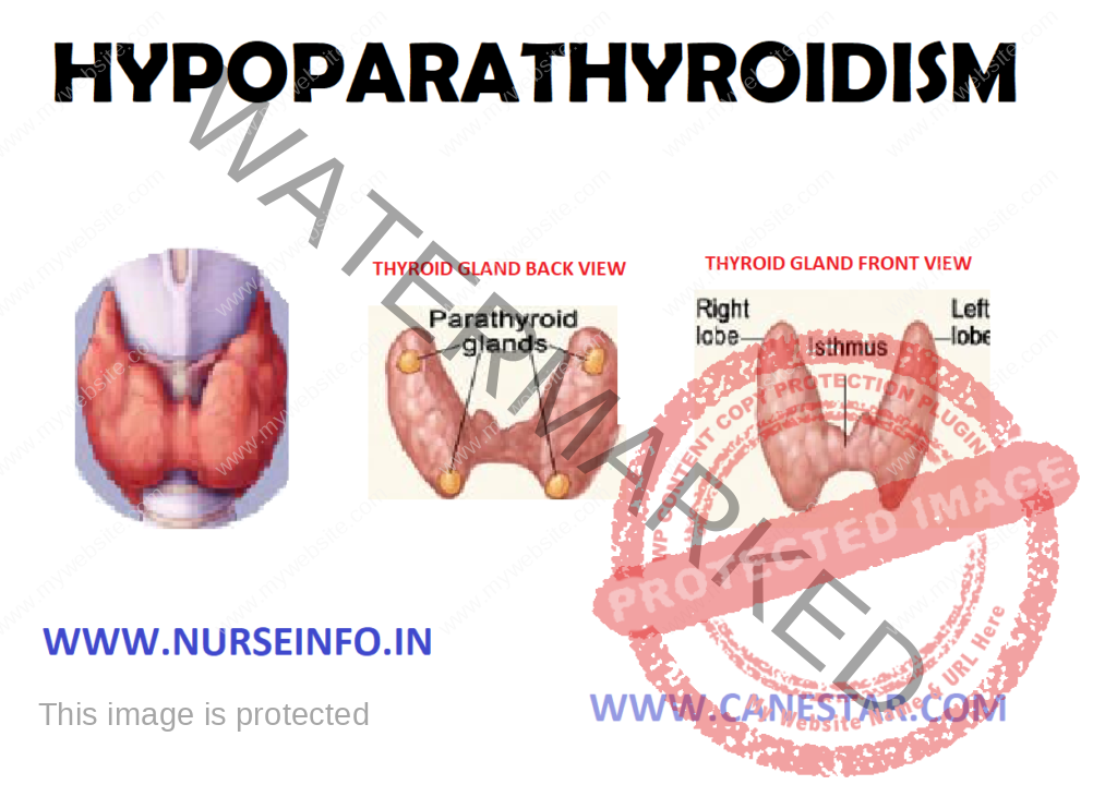 HYPOPARATHYROIDISM – Etiology, Risk Factors, Diagnostic Evaluation, Complication and Management  