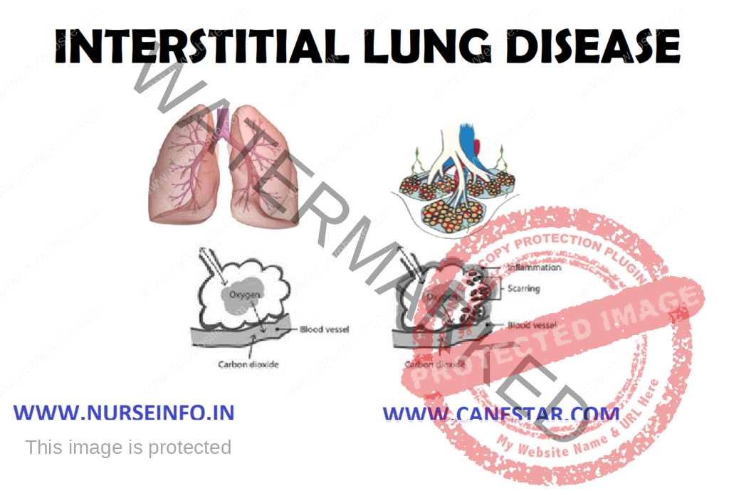 INTERSTITIAL LUNG DISEASE – Etiology, Risk Factors, Pathophysiology, Diagnostic Evaluations, Management and Complications 