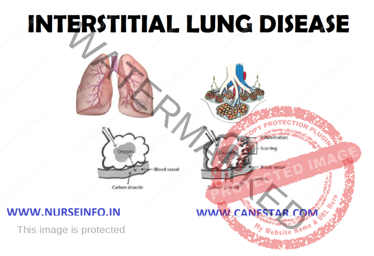 Interstitial INTERSTITIAL LUNG DISEASE - Nurse Info