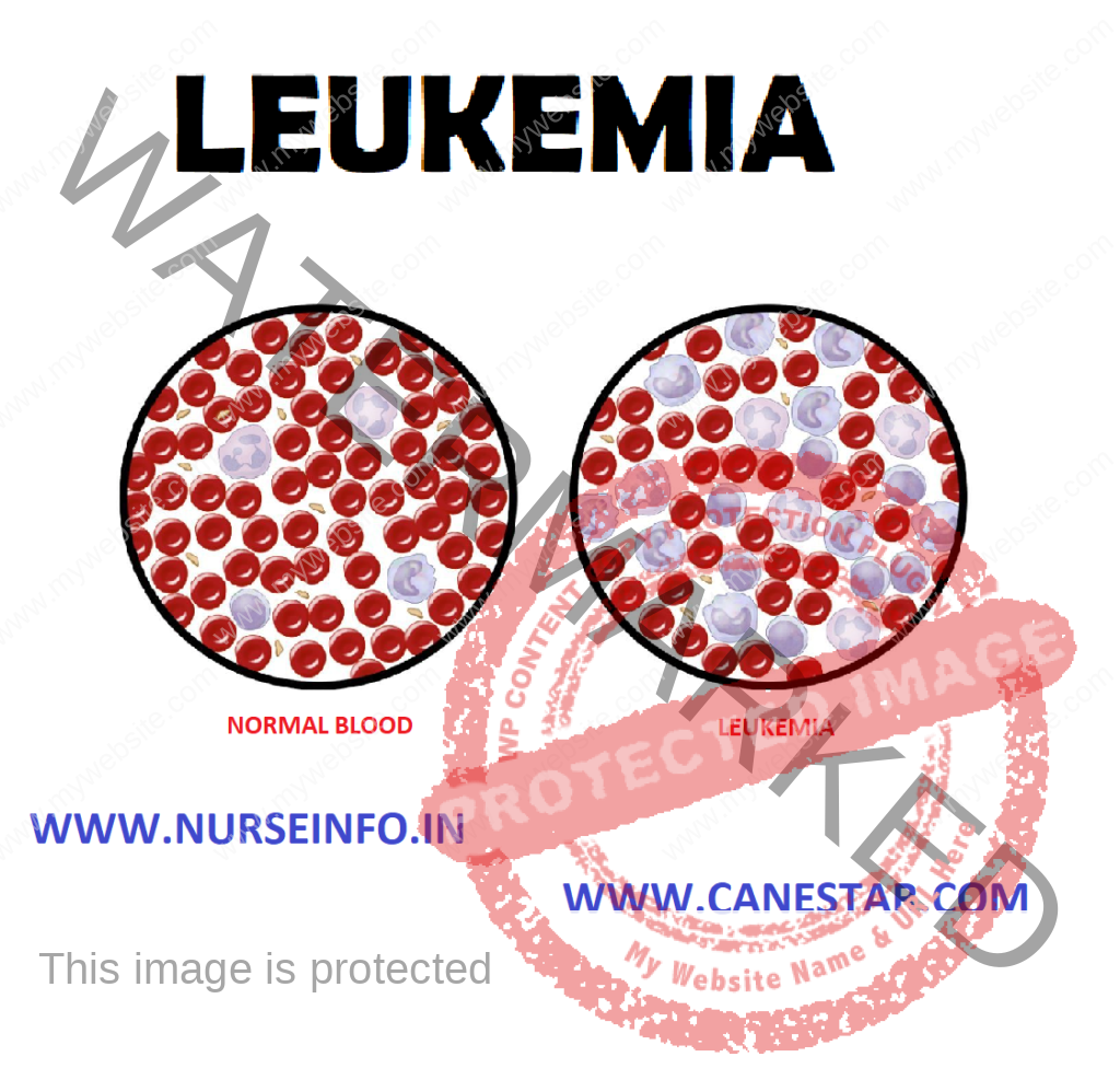 LEUKEMIA – Etiology and Pathophysiology, Risk Factors, Clinical Manifestations, Classification, treatment and Management 