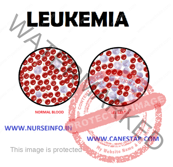 LEUKEMIA - Nurse Info