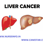 LIVER-CANCER-1