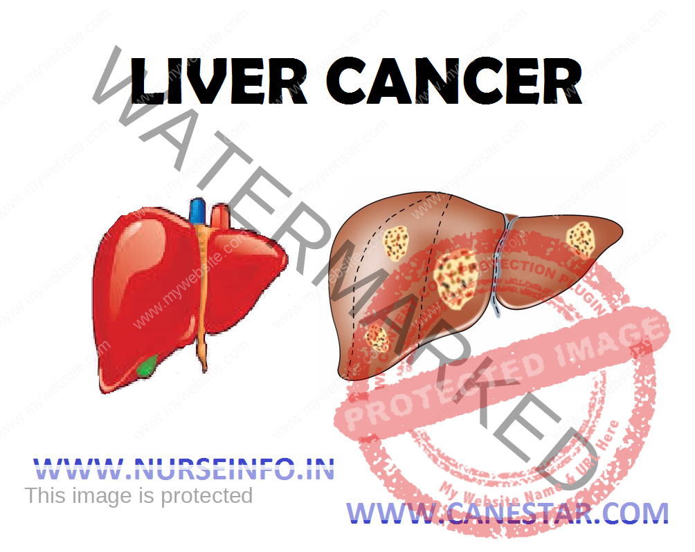 LIVER CANCER – Definition, Classification, Etiology and Risk Factors, Signs and Symptoms, Diagnostic Tests and Management 