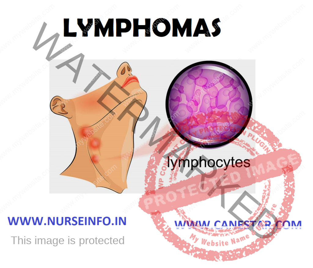 LYMPHOMAS – Types, Etiology, Pathophysiology, Stages, Clinical Manifestations, Diagnostic Evaluations and Management 