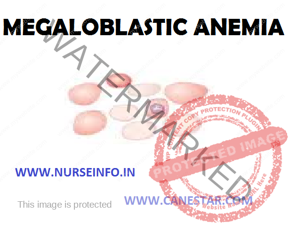 MEGALOBLASTIC ANEMIA – Types, Etiology, Clinical Manifestation, Diagnostic Evaluation and Management