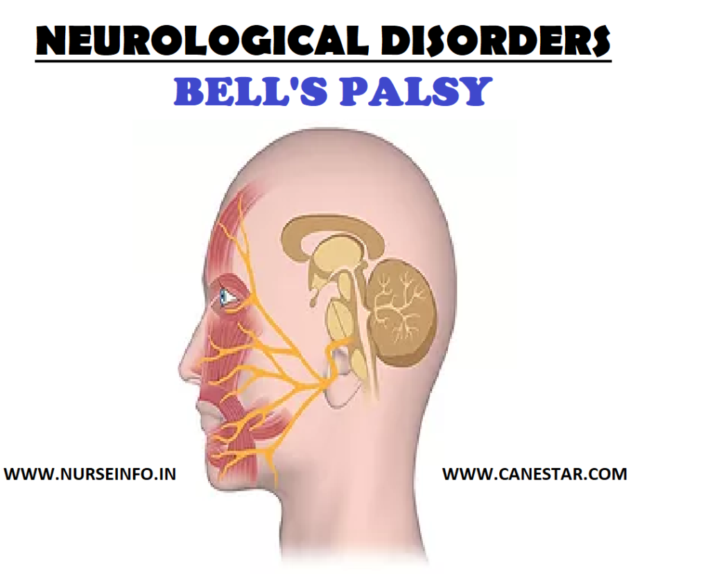 NEUROLOGICAL DISORDERS - BELL’S PALSY 
BELL’S PALSY – Etiology, Signs and Symptoms and Management (medical, surgical and nursing) 
