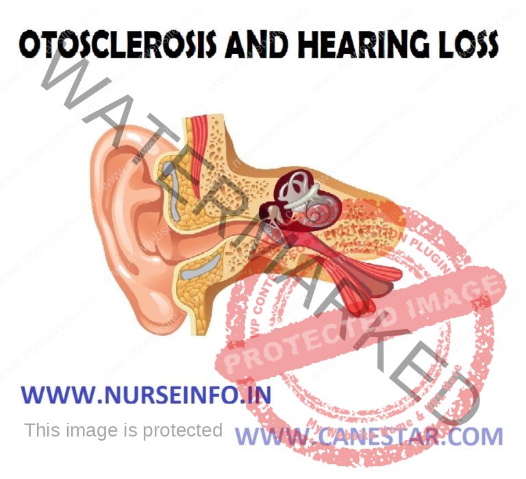 Otosclerosis And Hearing Loss Nurse Info