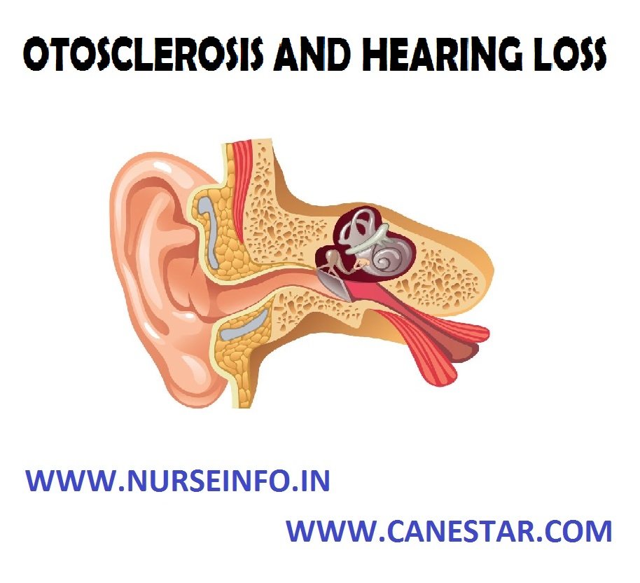 OTOSCLEROSIS AND HEARING LOSS (Etiology, Diagnostic Evaluation, Treatment and Management