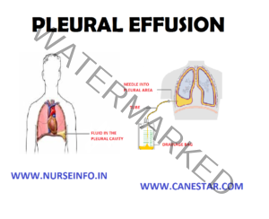 PLEURAL EFFUSION - Nurse Info