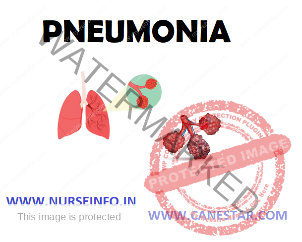 PNEUMONIA – Types, Pathophysiology, Signs and Symptoms, Diagnostic Evaluation and Management 