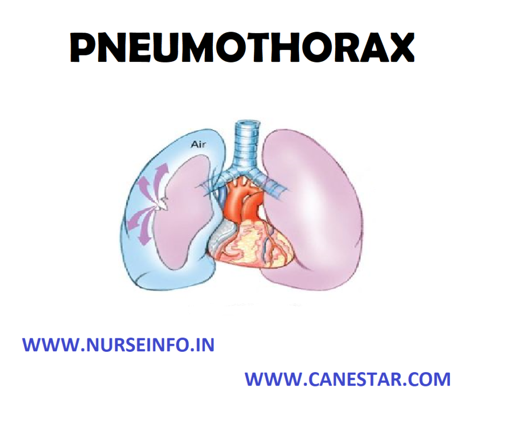 PNEUMOTHORAX - Classification, Etiology, Risk Factors, Pathophysiology, Signs and Symptoms, Diagnostic Evaluations and Management 