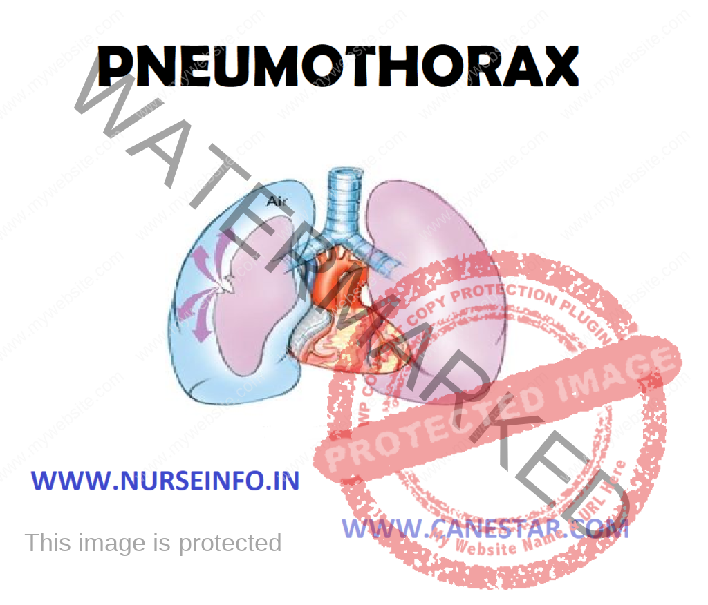 PNEUMOTHORAX - Classification, Etiology, Risk Factors, Pathophysiology, Signs and Symptoms, Diagnostic Evaluations and Management 