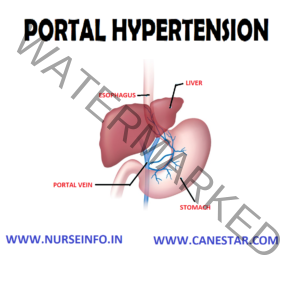 PORTAL HYPERTENSION - Nurse Info