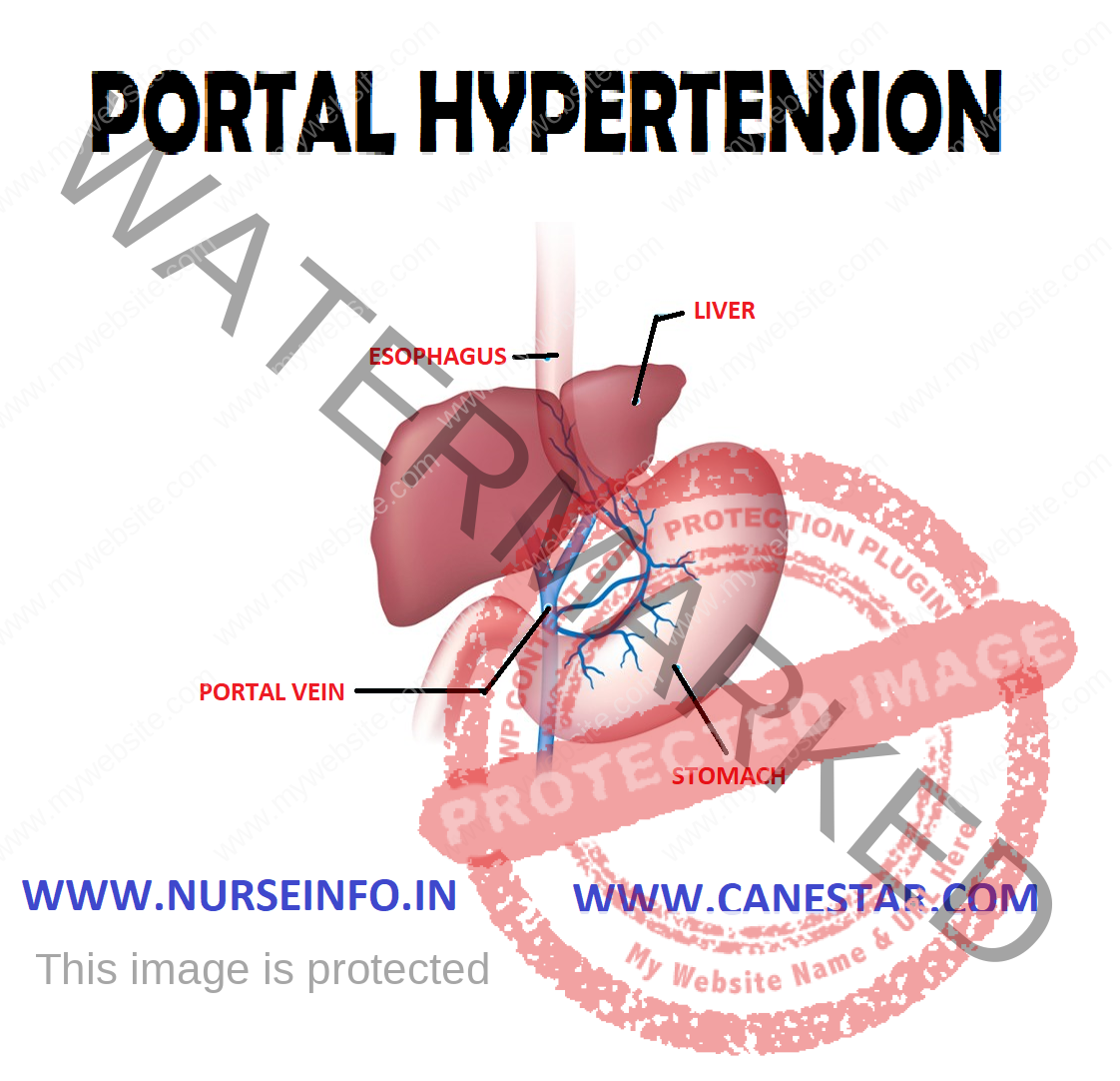 first presentation of portal hypertension