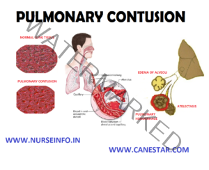 PULMONARY CONTUSION - Nurse Info