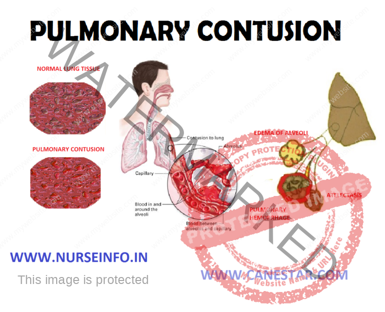 PULMONARY CONTUSION - Nurse Info