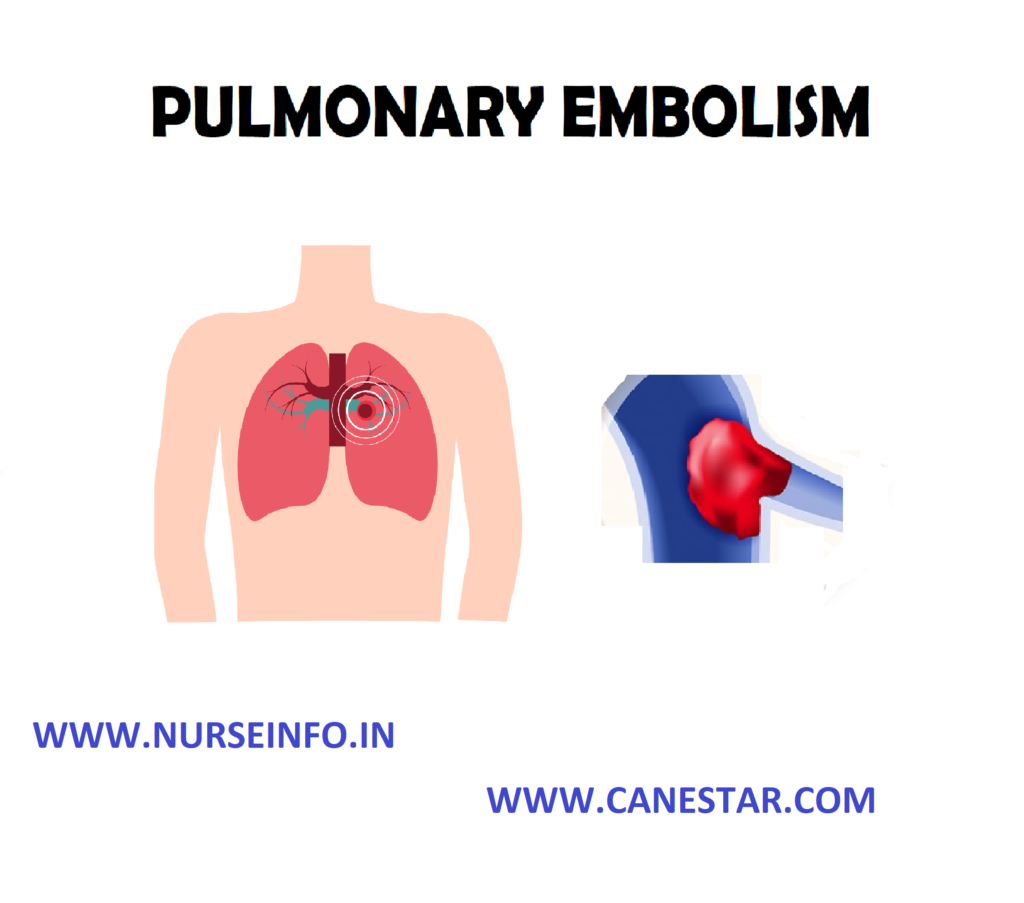 PULMONARY EMBOLISM – Etiology, Pathophysiology, Clinical Manifestation, Diagnostic Evaluation, Management and Complication
