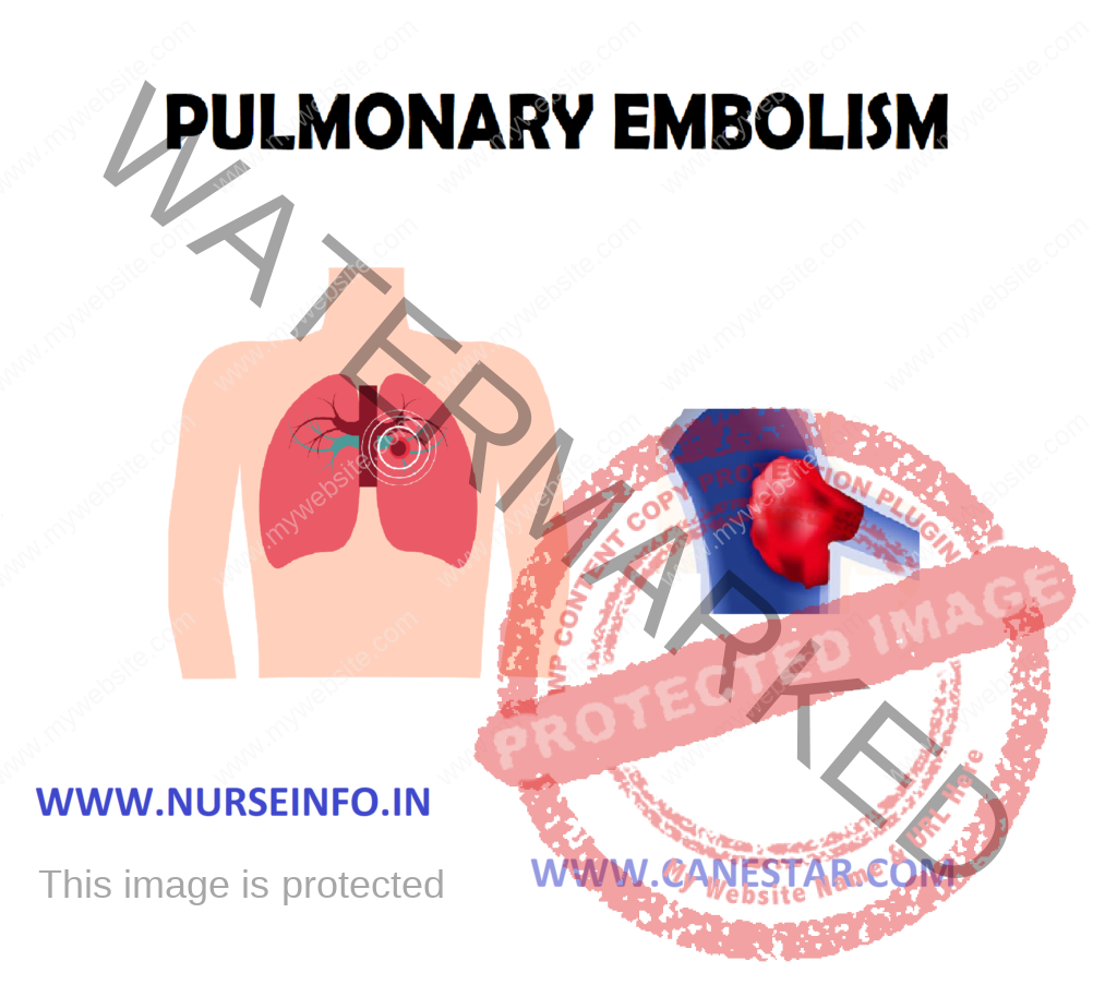 PULMONARY EMBOLISM – Etiology, Pathophysiology, Clinical Manifestation, Diagnostic Evaluation, Management and Complication 