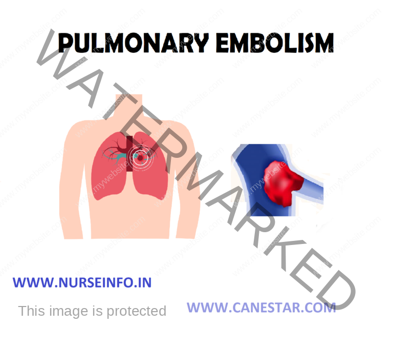 Pulmonary embolism surgery recovery