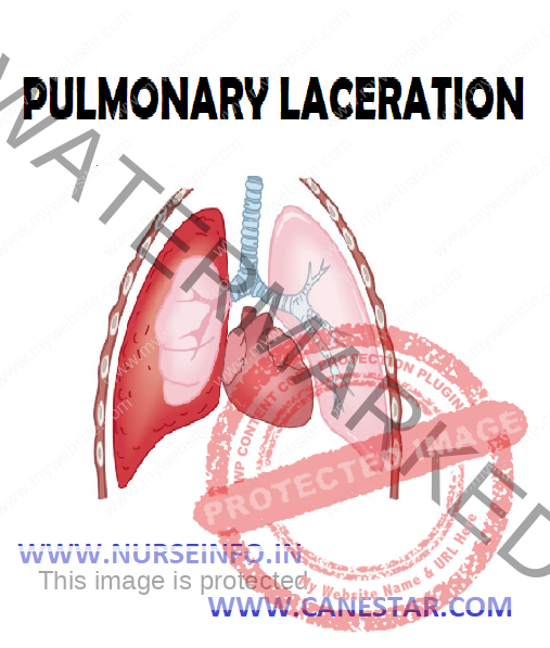 PULMONARY LACERATION – Etiology, Classification, Pathophysiology, Diagnostic Evaluation and Management 