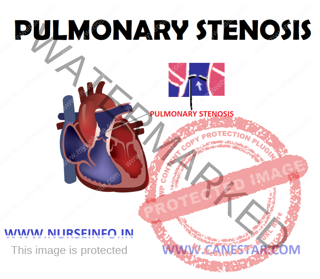 PULMONARY STENOSIS – Etiology, Risk Factors, Signs and Symptoms, Diagnostic Evaluations and Management 