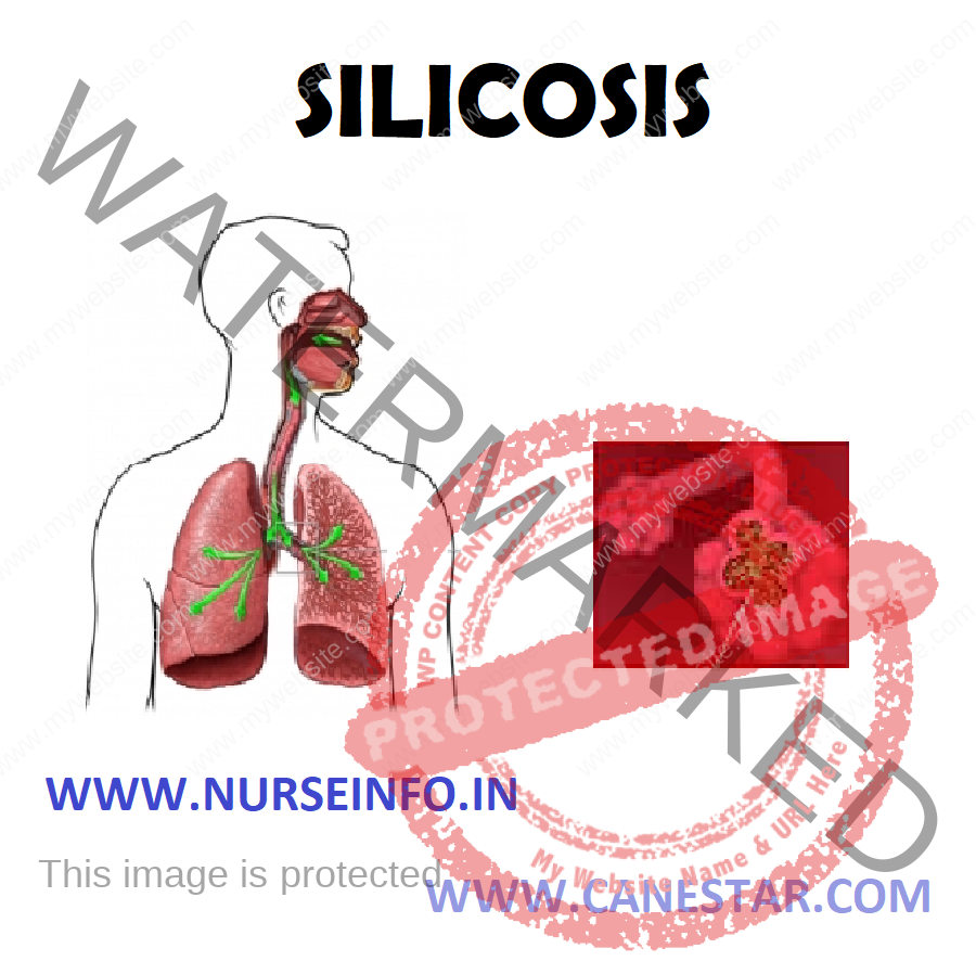 SILICOSIS – Classification, Etiology, Risk Factors, Pathophysiology, Signs and Symptoms, Diagnostic Test, Treatment and Prevention