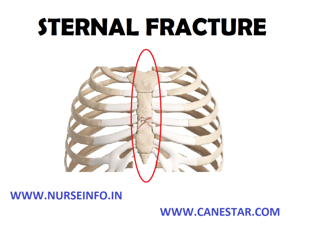 STERNAL FRACTURE – Etiology, Signs and Symptoms, Diagnostic Test and Treatment